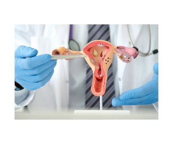 FIBROIDS